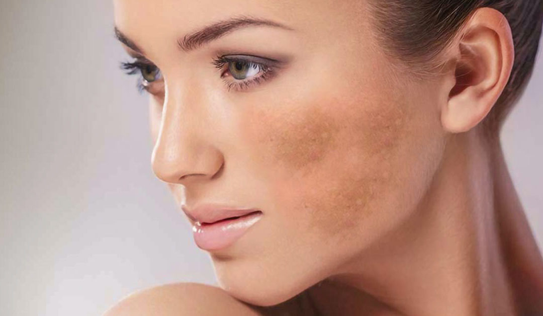 tipos de melasma